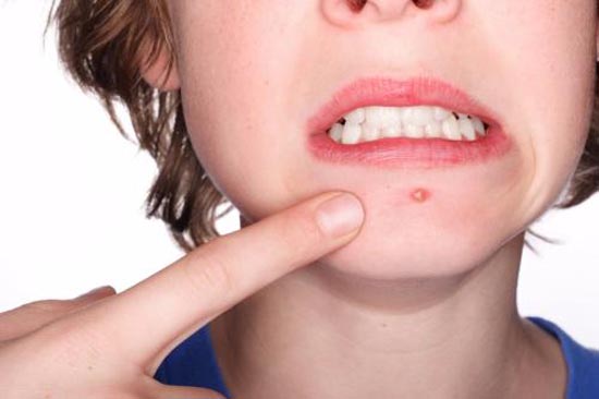 <b>脸上长痘痘的原因是什么？不同部位长痘痘的原因是什么？</b>
