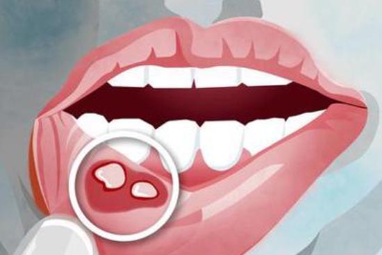 口腔溃疡的预防和治疗方法，怎